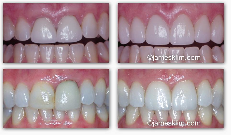 Non Metal Crowns James Klim, DDS
