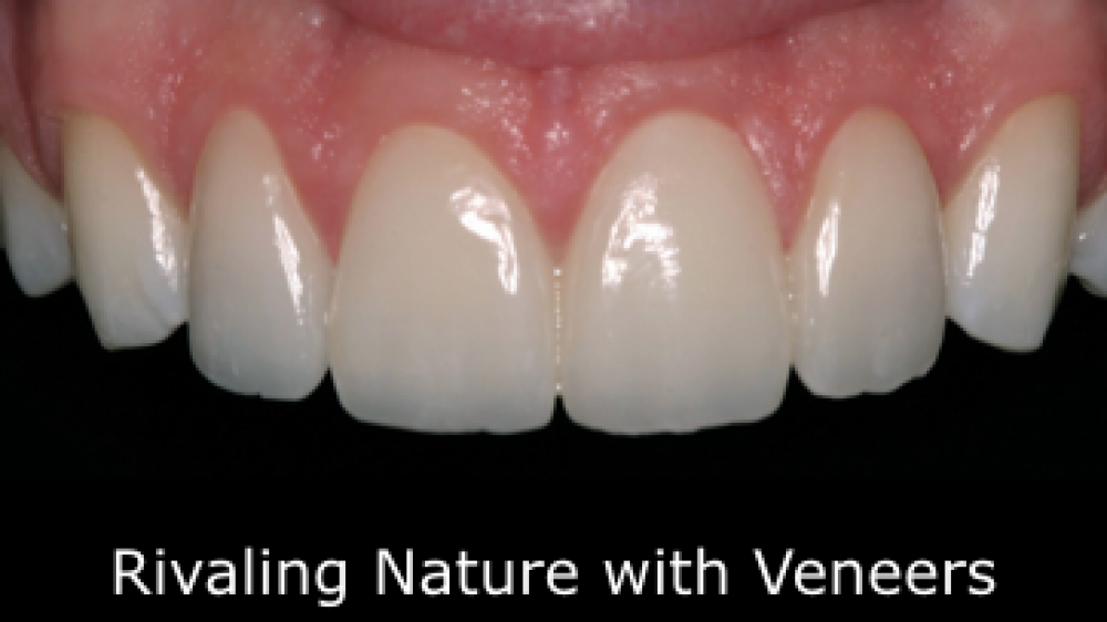 1-800-DENTIST – CEREC Blows my mind-HD.mp4.001