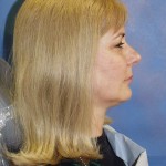 Copy of ShibleyFaceSideOrthotic