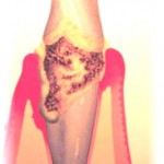 Illustative Perio lesion