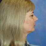 ShibleyFaceSideNoOrthotic