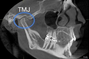 “TMJ” like symptoms MPD