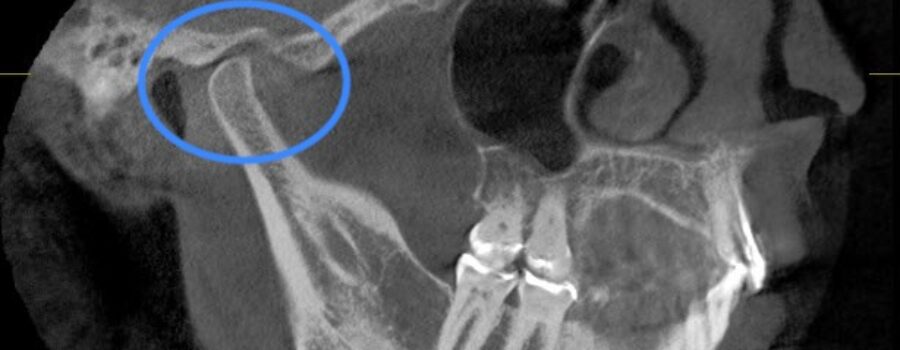 “TMJ” like symptoms MPD