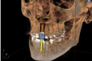 Missing Teeth Can Be a Thing of the Past