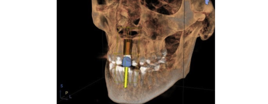 Missing Teeth Can Be a Thing of the Past