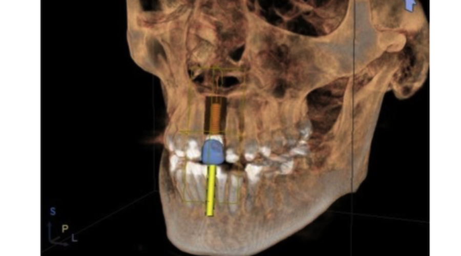 Missing Teeth Can Be a Thing of the Past